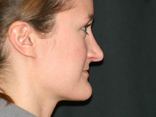 Rhinoplasty 01 After - 2