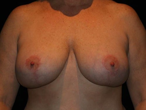 Breast Lift 01 After