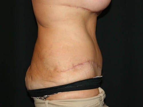 Tummy Tuck 01 After - 2