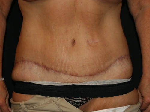 Tummy Tuck 01 After