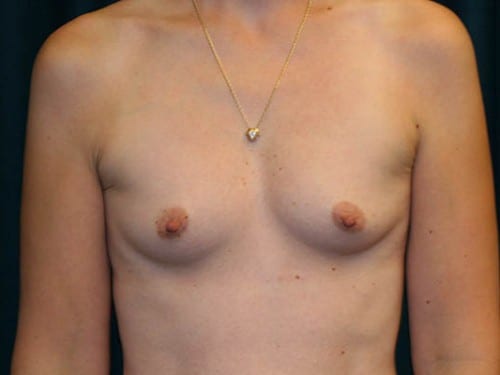 Breast Augmentation 02 Before