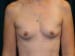 Breast Augmentation 02 Before - Thumbnail