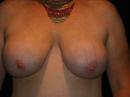 Breast Lift 01 Before