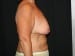 Breast Augmentation 03 Before - 2 - Thumbnail