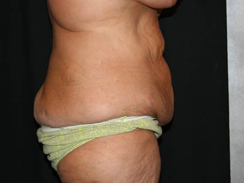 Tummy Tuck 01 Before - 2