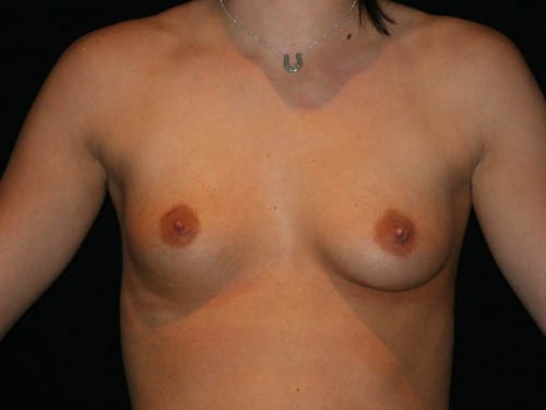 Breast Augmentation 01 Before