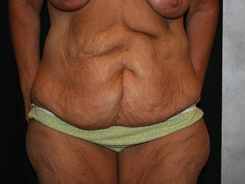 Tummy Tuck 01 Before