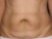 Tummy Tuck 02 Before - Thumbnail