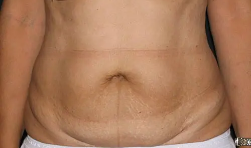 Tummy Tuck 02 Before