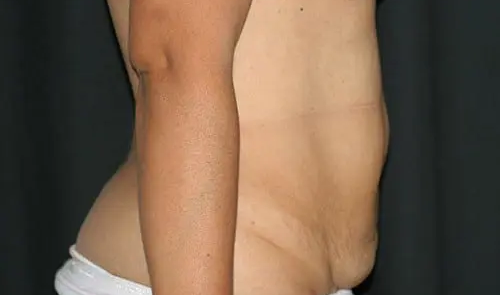 Tummy Tuck 02 Before - 2