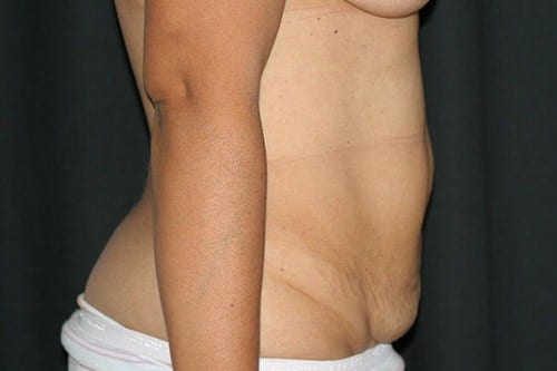 Tummy Tuck 02 Before - 2