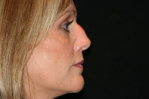 Rhinoplasty 03 Before - 2