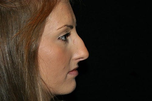 Rhinoplasty 04 Before - 2