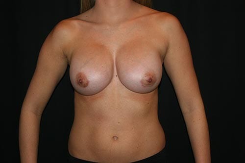 Breast Augmentation 05 After