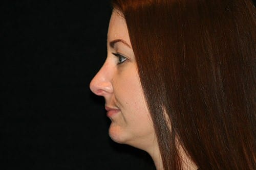 Rhinoplasty 02 After - 2