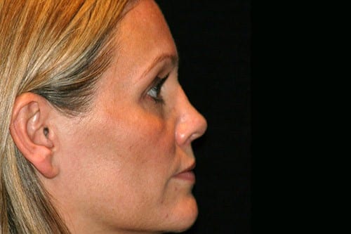 Rhinoplasty 03 After - 2