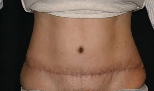 Tummy Tuck 02 After