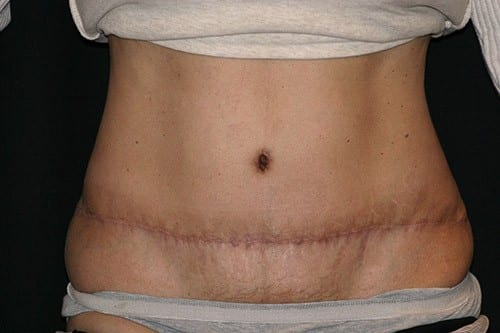 Tummy Tuck 02 After