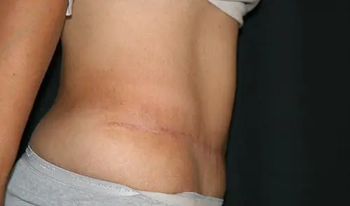 Tummy Tuck 02 After - 2