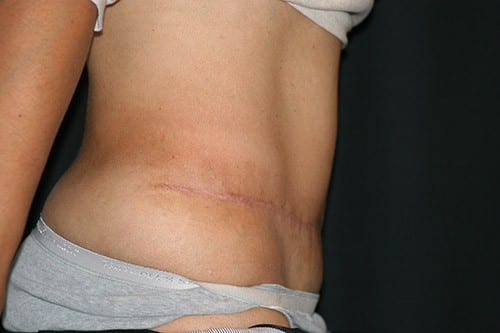 Tummy Tuck 02 After - 2
