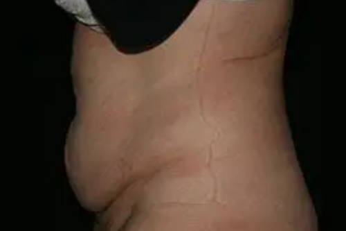 Tummy Tuck 03 Before - 2