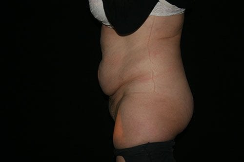Tummy Tuck 03 Before - 2