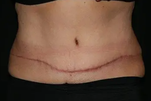 Tummy Tuck 03 After