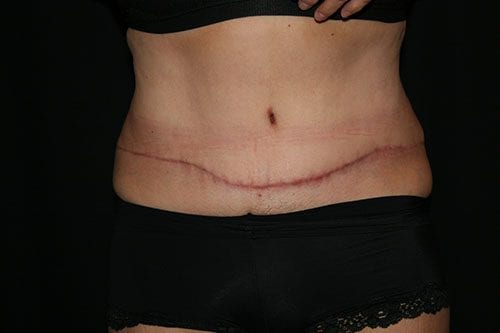 Tummy Tuck 03 After