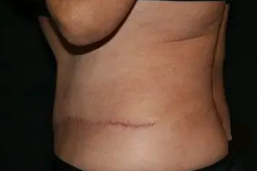 Tummy Tuck 03 After - 2