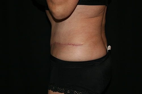 Tummy Tuck 03 After - 2