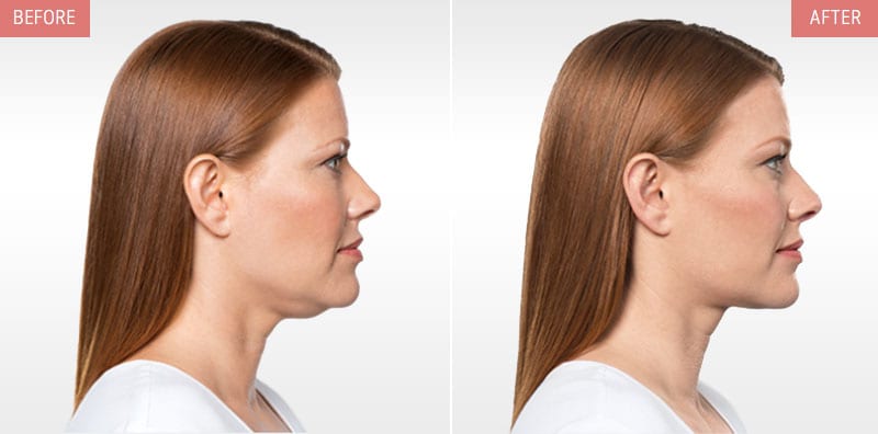 Kybella Treatment Before and After Results