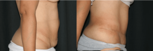 Before and After Tummy Tuck