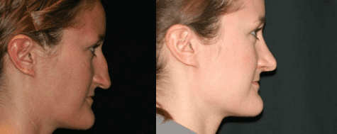 Rhinoplasty Before and After Photos