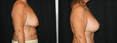 Breast Augmentation Before and After Photos by Dr. Bonaldi