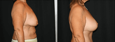 https://www.bonaldimd.com/wp-content/uploads/2017/06/Breast-Augmentation-Before-and-After-Photos-by-Dr.-Bonaldi.png