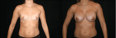 Dr. Bonaldi Before and After photos for Breast Aug