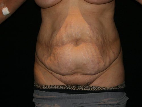 Tummy Tuck 04 Before