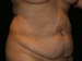 Tummy Tuck 04 Before - 2 - Thumbnail