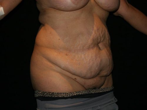 Tummy Tuck 04 Before - 2