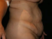 Tummy Tuck 04 Before - 4 - Thumbnail