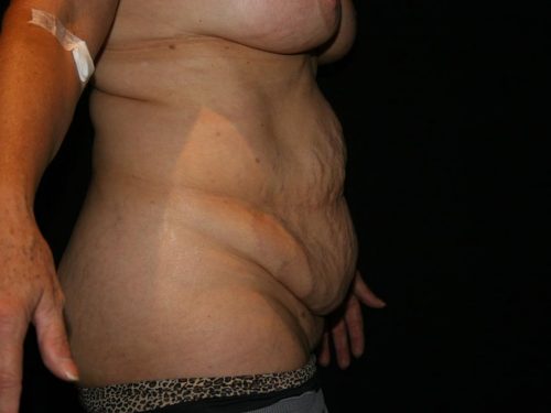 Tummy Tuck 04 Before - 3
