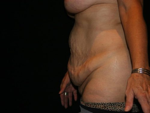 Tummy Tuck 04 Before - 4