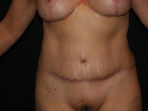 Tummy Tuck 04 After