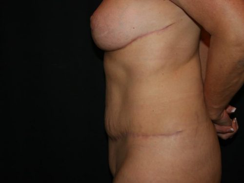 Tummy Tuck 04 After - 4