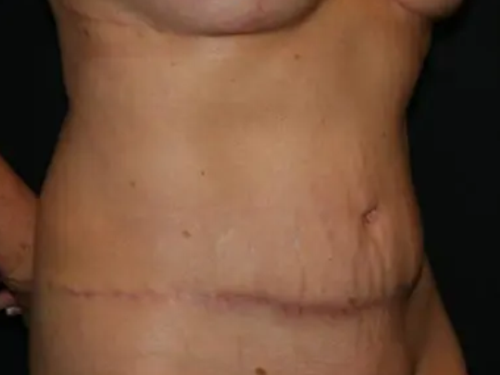 Tummy Tuck 04 After - 2