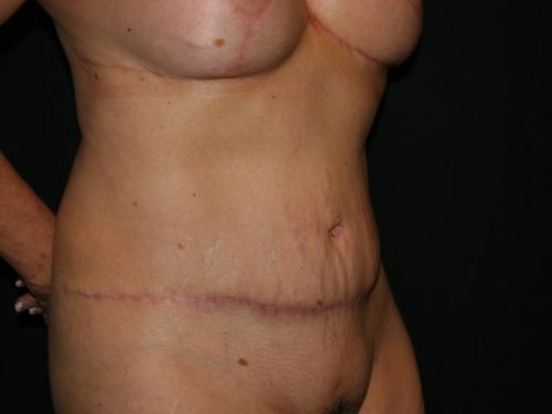 Tummy Tuck 04 After - 2