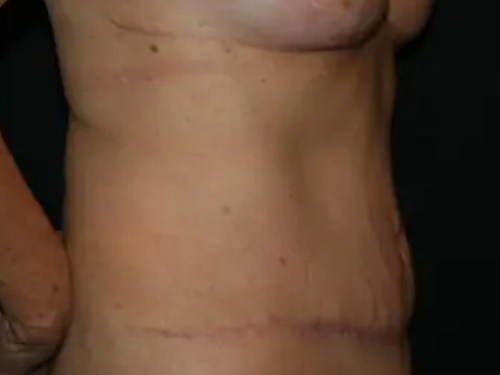 Tummy Tuck 04 After - 4