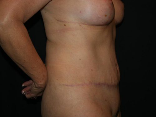 Tummy Tuck 04 After - 3