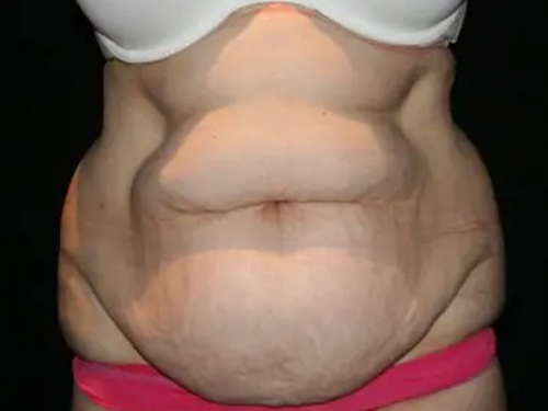 Tummy Tuck 05 Before