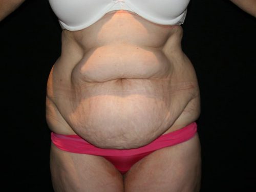 Tummy Tuck 05 Before